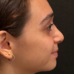 Rhinoplasty Before & After Patient #9758