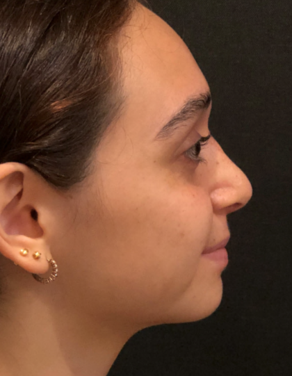 Rhinoplasty Before & After Patient #9758