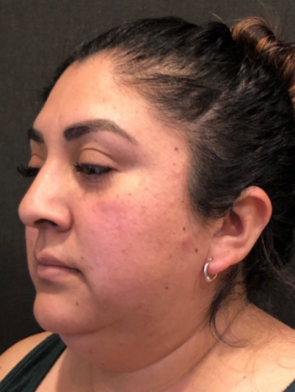 Chin Liposuction Before & After Patient #9507