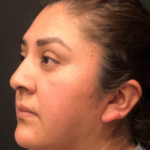 Chin Liposuction Before & After Patient #9507