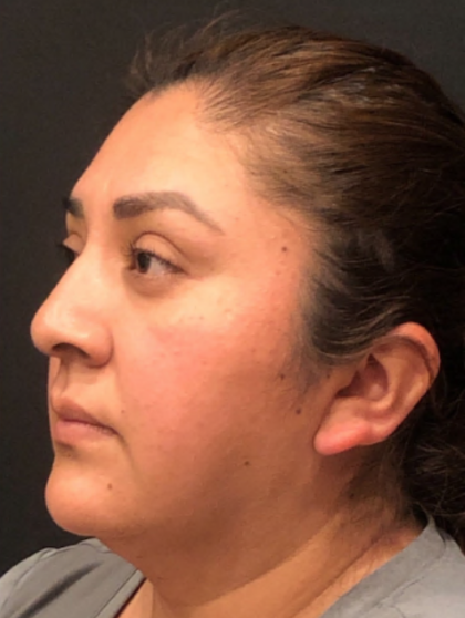 Chin Liposuction Before & After Patient #9507