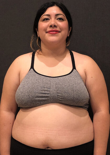 Patient 9732 Gastric Balloon Before And After Photos Marin Plastic Surgery Gallery San Francisco Dr Stanley Poulos