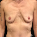 Breast Augmentation Before & After Patient #9984