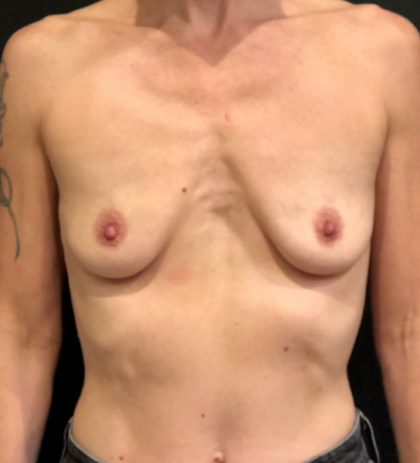 Breast Augmentation Before & After Patient #9984