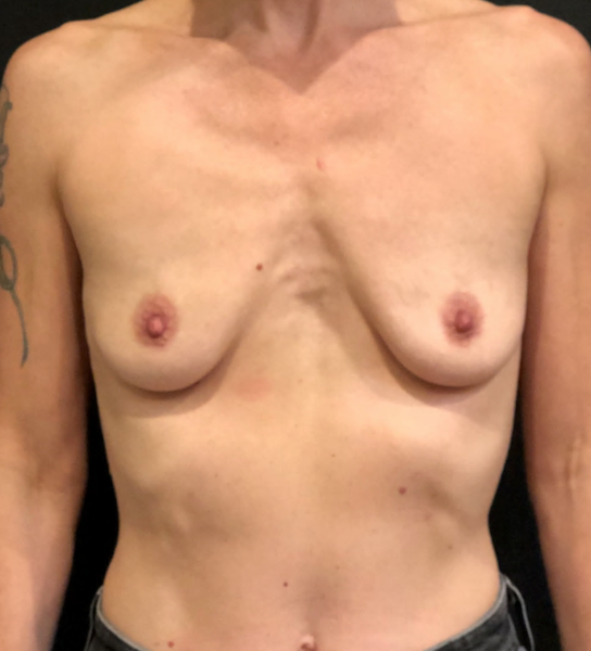 Breast Augmentation Before & After Patient #9984