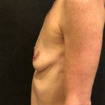 Breast Augmentation Before & After Patient #9984