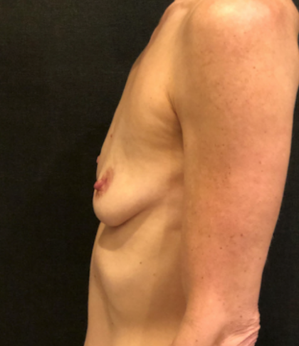 Breast Augmentation Before & After Patient #9984