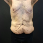 Body Lift Before & After Patient #10308