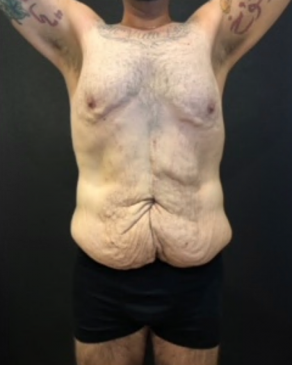 Body Lift Before & After Patient #10308