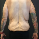 Body Lift Before & After Patient #10308