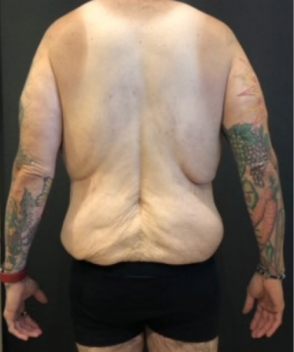 Body Lift Before & After Patient #10308