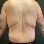 Body Lift Before & After Patient #10308