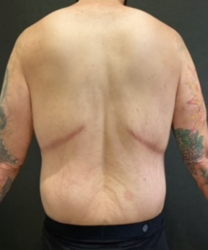 Body Lift Before & After Patient #10308