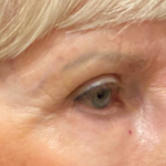 Eyelid Surgery Before & After Patient #10360