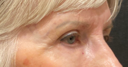 Eyelid Surgery Before & After Patient #10360