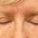 Eyelid Surgery Before & After Patient #10360