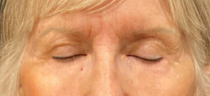 Eyelid Surgery Before & After Patient #10360