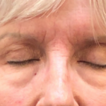 Eyelid Surgery Before & After Patient #10360