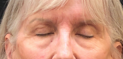 Eyelid Surgery Before & After Patient #10360