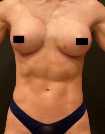 Breast Augmentation Before & After Patient #10386