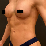 Breast Augmentation Before & After Patient #10386