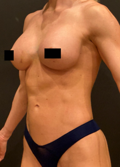 Breast Augmentation Before & After Patient #10386