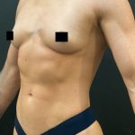 Breast Augmentation Before & After Patient #10386