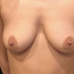 Breast Augmentation Before & After Patient #10408