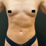 Breast Augmentation Before & After Patient #10386