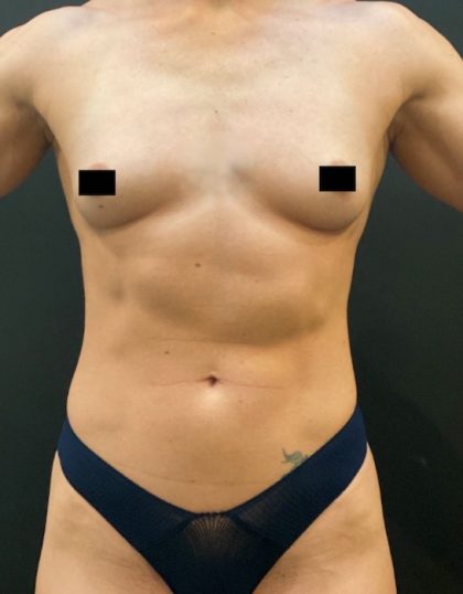 Breast Augmentation Before & After Patient #10386