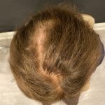 Hair Restoration with PRP Before & After Patient #10540