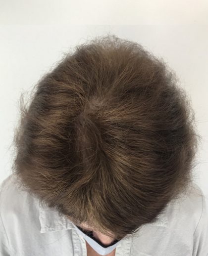 Hair Restoration with PRP Before & After Patient #10540