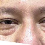 Eyelid Surgery Before & After Patient #10586