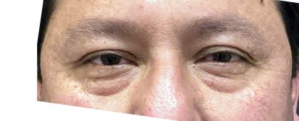Eyelid Surgery Before & After Patient #10586