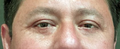 Eyelid Surgery Before & After Patient #10586