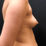 Breast Augmentation Before & After Patient #10471