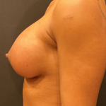 Breast Augmentation Before & After Patient #10464