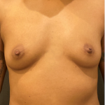 Breast Augmentation Before & After Patient #10464