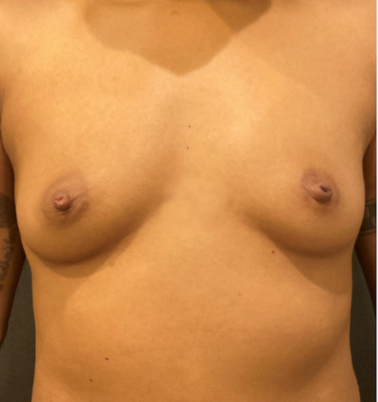 Breast Augmentation Before & After Patient #10464