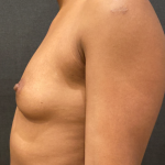 Breast Augmentation Before & After Patient #10464