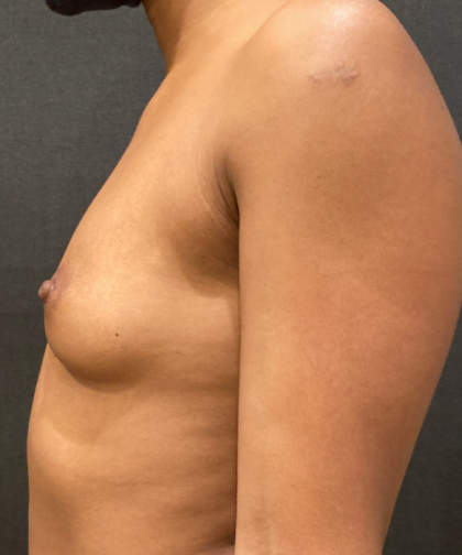 Breast Augmentation Before & After Patient #10464