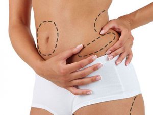 Liposuction of the abdomen and flanks, Plastic Surgeon San Francisco