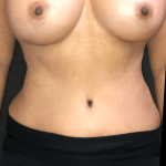 Renuvion Before & After Patient #10739