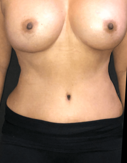 Renuvion Before & After Patient #10739
