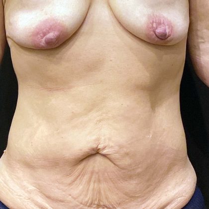 Tummy Tuck Before & After Patient #10713