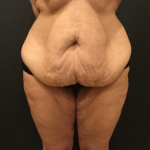 Liposuction Before & After Patient #10734