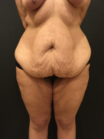 Liposuction Before & After Patient #10734