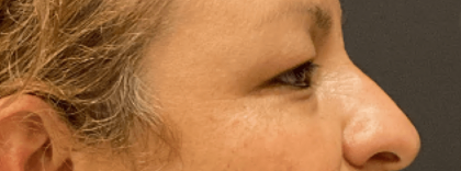 Eyelid Surgery Before & After Patient #10820