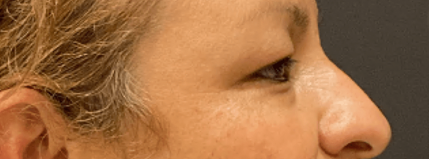 Eyelid Surgery Before & After Patient #10820