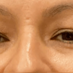 Eyelid Surgery Before & After Patient #10820